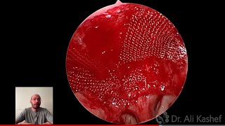 How to deal with intra operative adenoidectomy bleeding different techniques [upl. by Nnave]