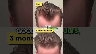 Microneedling your scalp to regrow hair [upl. by Kenyon]