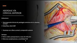 Mielopatía cervical espondiloartrósica Parte 2 Mielopatía por canal cervical estrecho [upl. by Delano]