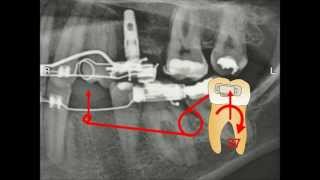 Dr Burstones Legacy [upl. by Law]