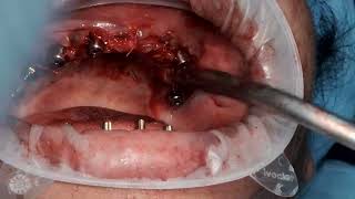 Upper full mouth suturing by using vicryl rapide [upl. by Avika]