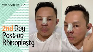 Rhinoplasty In the Philippines 2nd Day Post Opp [upl. by Rosamond787]