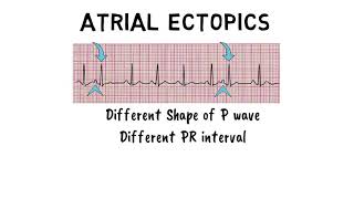 ATRIAL ECTOPICS [upl. by Ellehciram]