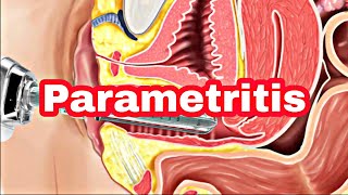 ParametritisCausesSymptoms DiagnosisTreatment And Surgical Procedures [upl. by Silverstein]