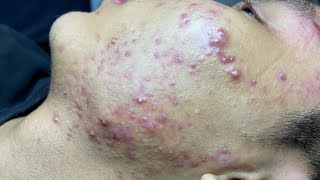 ACNE TREATMENT VU QUYNH MI Blackheads On Boy Face 2024 [upl. by Anelrats]