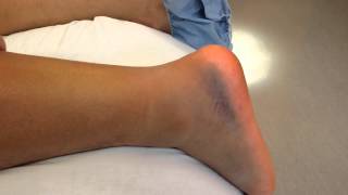 Quick test for an Achilles tendon rupture [upl. by Brandon150]