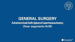 Vivostat Fibrin used for anatomical left lateral sectionectomy [upl. by Ahsekad]