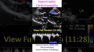 Hypertrophic Cardiomyopathy [upl. by Imuya778]