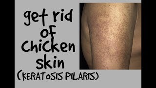 HOW TO GET RID OF CHICKEN SKIN KERATOSIS PILARIS DR DRAY [upl. by Ayinat269]