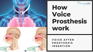 Voice After After Total Laryngectomy  Laryngectomy  Provox Vega [upl. by Euqirdor502]