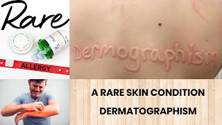 A RARE SKIN CONDITION  DERMATOGRAPHISM  CAUSES  TREATMENT  LIFE STYLE MODIFICATIONS [upl. by Arehs481]