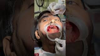 Suturing in Alveoloplasty l 7044611705 l part 2 l DrArindam Mandalmaxillofacialsurgery [upl. by Shoshana]