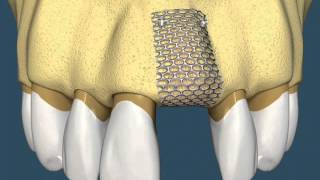 Implantes Dentários  Com Enxerto Ósseo [upl. by Celestine]