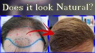 Ive asked people what do they think about my HAIR TRANSPLANT [upl. by Lacram491]