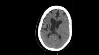 CT Chronic Basal Ganglia infarcts and Anatomy DISCUSSION by Radiologist [upl. by Enoval]