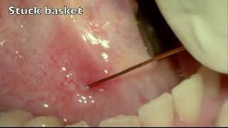 SIALENDOSCOPY FOR SIALOLITHIASIS IN SUBMANDIBULAR GLAND  SELDINGER TECHNIQUE  DISTAL PAPILLOTOMY [upl. by Enaj]