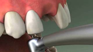 Dentist  Maryland Bridge Procedure [upl. by Jacki]