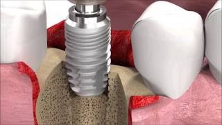 SIC invent Dental Implant Procedure SICmax implant insertion [upl. by Riabuz]