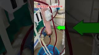 Dialyzer rupture hemodialysis ckdpatient hospital [upl. by Platt]