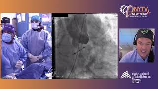 Live Case 2 – Evolut Pro CoreValve [upl. by Wandie]