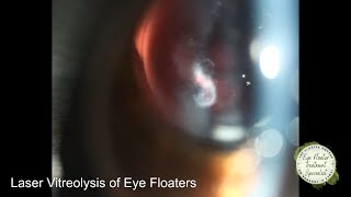 INACCESSIBLE EYE FLOATERS USING A MIRRORED LENS [upl. by Nnairb]