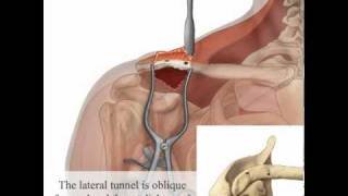 LARS Ligament ACJmov [upl. by Ainolloppa]