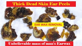 TOTAL OBSTRUCTION  EAR WAX REMOVAL  FULLHD  202312 relaxing satisfying asmr [upl. by Deck]