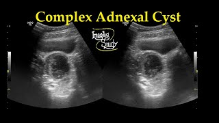 Complex Adnexal Cyst  Ultrasound  Case 27 [upl. by Nimsay]