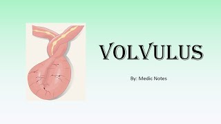 Volvulus  risk factors clinical features investigation treatment complication [upl. by Akeimahs]