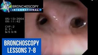 Bronchoscopy Step by Step Details Lessons 78 [upl. by Talmud]