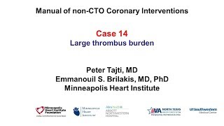 Case 14 PCI Manual Large coronary thrombus [upl. by Fadil]