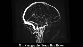 MR venography [upl. by Jerry]