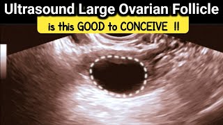 what is Large Ovarian Follicle  is it GOOD to CONCEIVE  TVS Ultrasound [upl. by Yeliab]