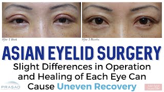 Asian Eyelid Surgery  Why Location of Incision is Not the Same as Final Crease Position [upl. by Moran462]