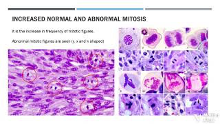 Features of Epithelial Dysplasia [upl. by Rafaela684]