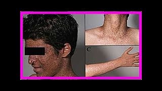 Xeroderma pigmentosum was es ist Symptome und wie die Behandlung ist [upl. by Ccasi]