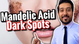 Mandelic Acid for Hyperpigmentation and Dark Spots  How to Use Mandelic Acid CORRECTLY [upl. by Ecire]