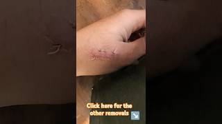 Suture Self removal after 2 weeks video no1 weird health healing [upl. by Rugen565]