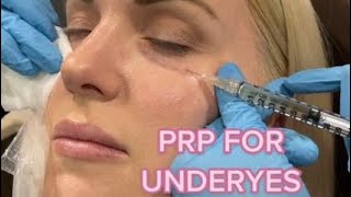 Undereye PRP Injections [upl. by Melisa8]