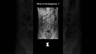 Posttraumatic ileus Abdominal Xray Abnormalities Postoperative ileus 67 radiologychannel007 [upl. by Genesa]