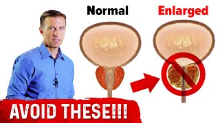 4 Things to Avoid if You Have an Enlarged Prostate – Dr Berg [upl. by Aicenev]