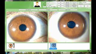 Iridology Camera 9822U software operation Video 3201 Version [upl. by Yllut]