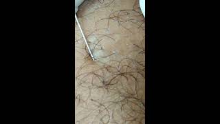 ingrown hair removal satisfying 2019 [upl. by Pogah]