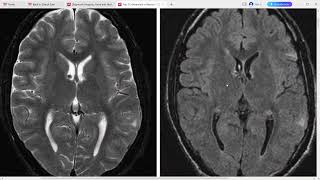 TOP 3 DIFFERENTIALS IN NEURORADIOLOGY [upl. by Waldo]