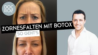 ZORNESFALTE mit BOTOX behandeln – darauf muss man achten Dr Rolf Bartsch [upl. by Anaya]