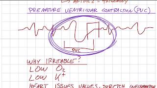 EKG 311  More on PVCs [upl. by Aniwde896]