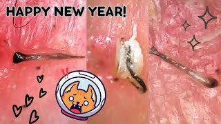 Hair Follicle Plucks Under the Microscope Super Satisfying Ingrown Hair Removal  BIG Hair Roots [upl. by Cherey399]