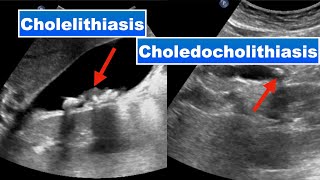 Cholelithiasis and choledocholithiasis I Ultrasound [upl. by Newra207]