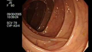 Colonoscopy Demonstrating a Moving Worm  NEJM [upl. by Origra]