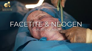 Facetite amp Neogen  Yorkshire Skin Centre  Dr Raj Thethi [upl. by Aiz]